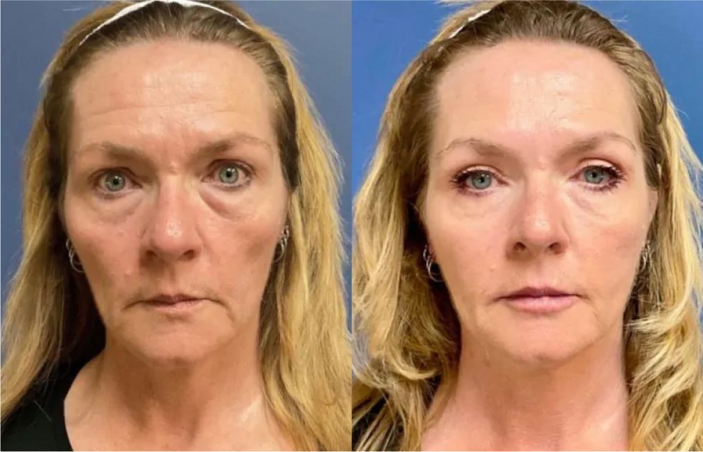 santa rosa med spa patient before and after