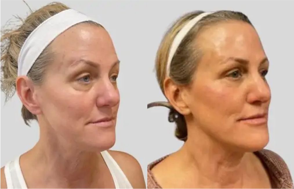 santa rosa med spa patient before and after