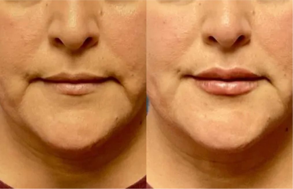 santa rosa med spa patient before and after