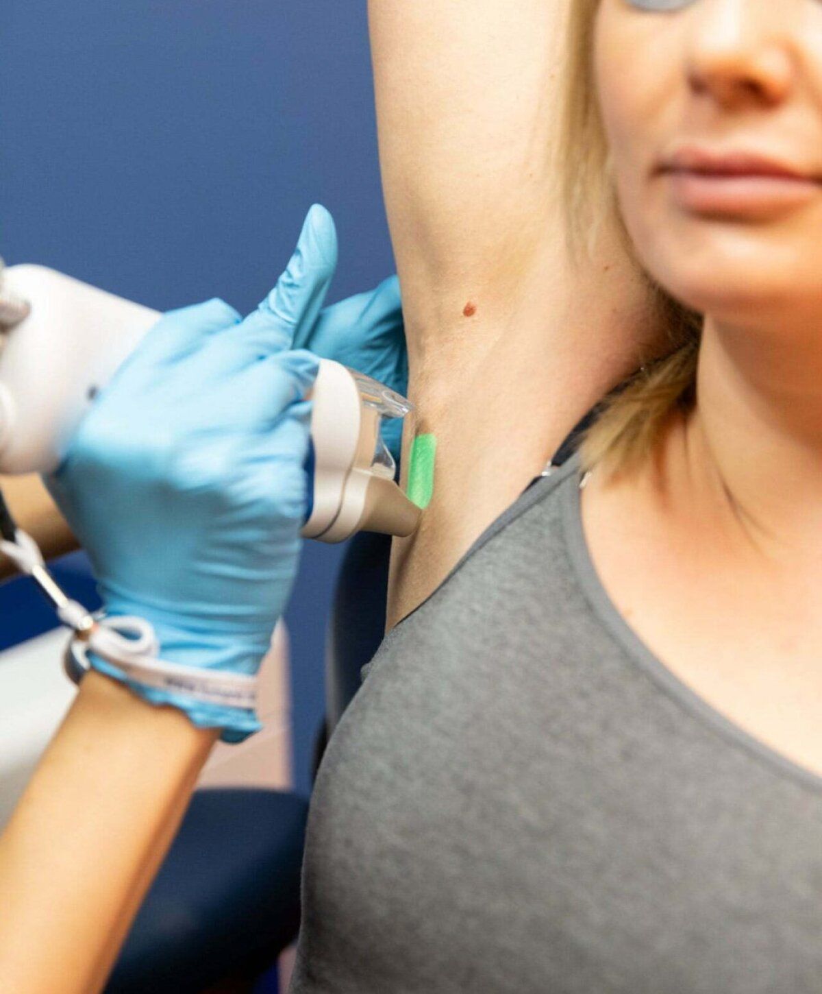 santa rosa hair removal patient receiving treatment