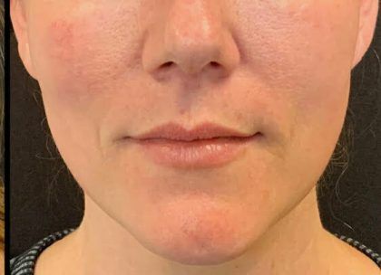 Botox Before & After