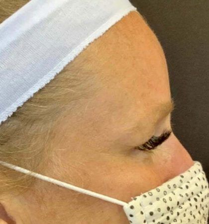 Botox Before & After