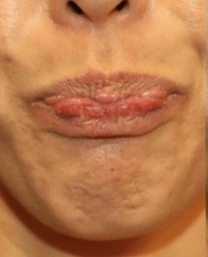 Botox Before & After