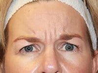 Botox Before & After