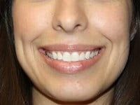 Botox Before & After