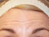 Botox Before & After