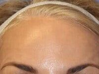 Botox Before & After