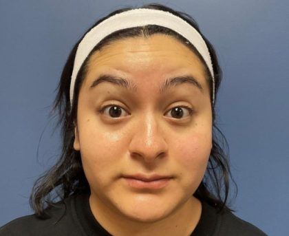 Botox Before & After