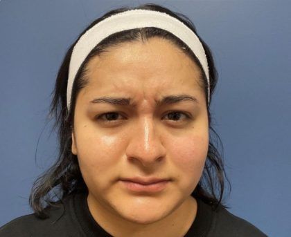 Botox Before & After