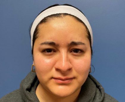 Botox Before & After