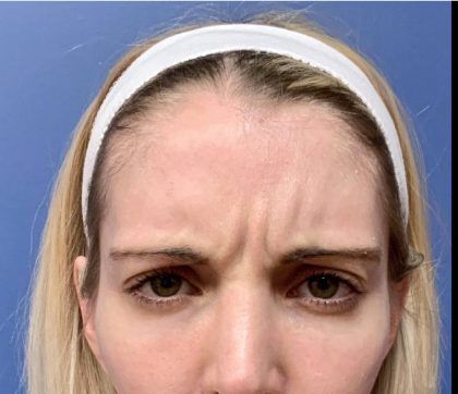 Botox Before & After