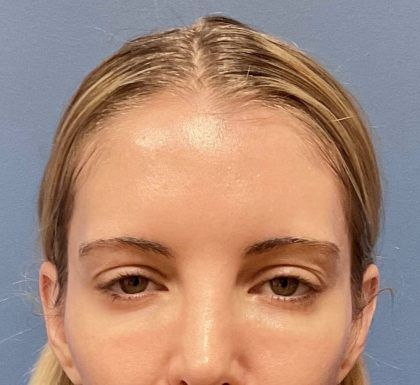 Botox Before & After