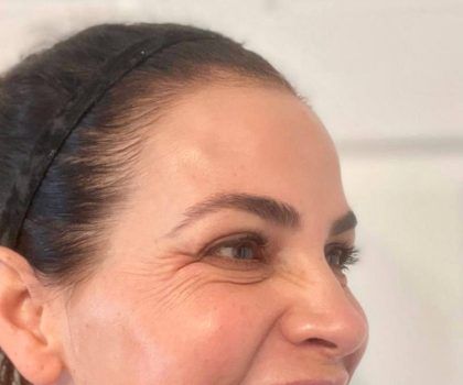 Botox Before & After