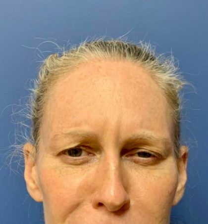 Botox Before & After