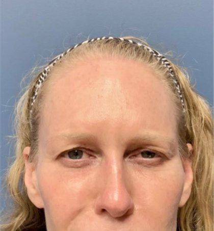 Botox Before & After