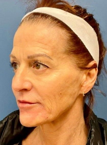 Botox Before & After