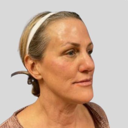 Botox Before & After