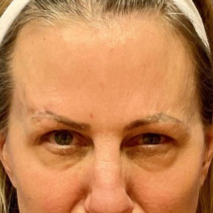 Botox Before & After