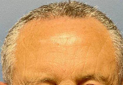 Botox Before & After