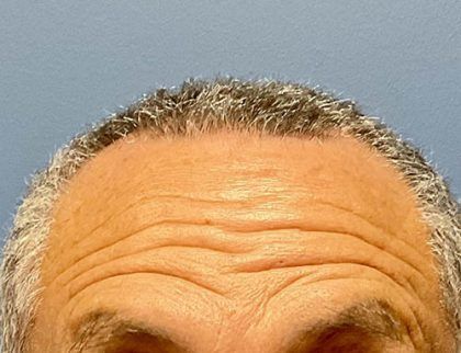 Botox Before & After