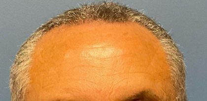 Botox Before & After