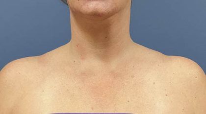 Botox Before & After