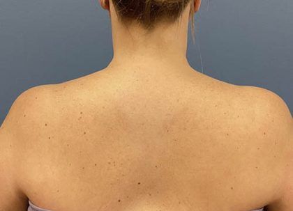 Botox Before & After