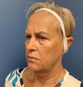 Botox Before & After