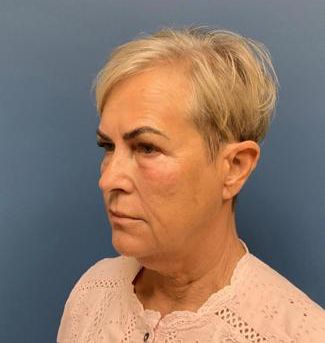 Botox Before & After