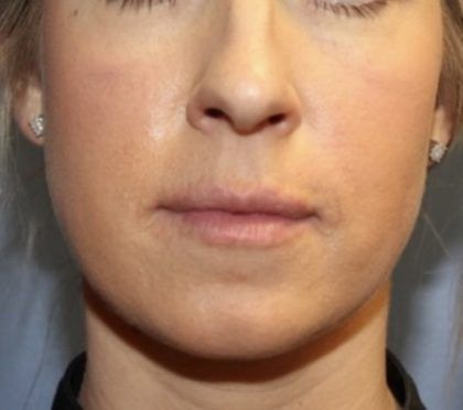 Botox Before & After