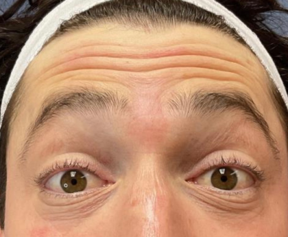 Botox Before & After