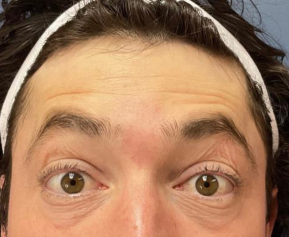 Botox Before & After