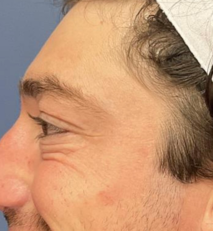 Botox Before & After