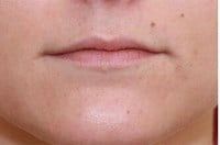 Fillers Before & After