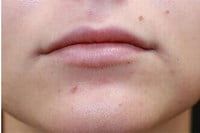 Fillers Before & After