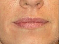 Fillers Before & After