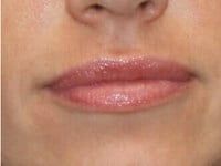 Fillers Before & After