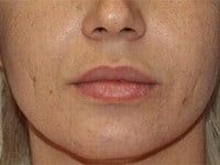 Fillers Before & After