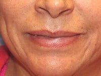 Fillers Before & After