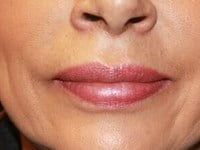 Fillers Before & After