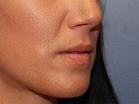 Fillers Before & After