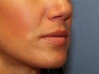 Fillers Before & After