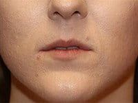 Fillers Before & After