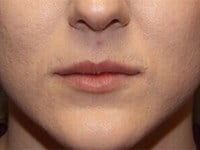 Fillers Before & After