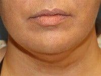 Fillers Before & After