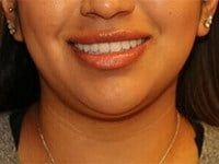 Fillers Before & After