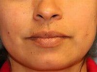 Fillers Before & After