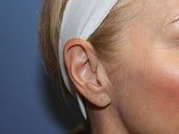 Fillers Before & After