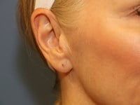 Fillers Before & After