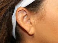 Fillers Before & After